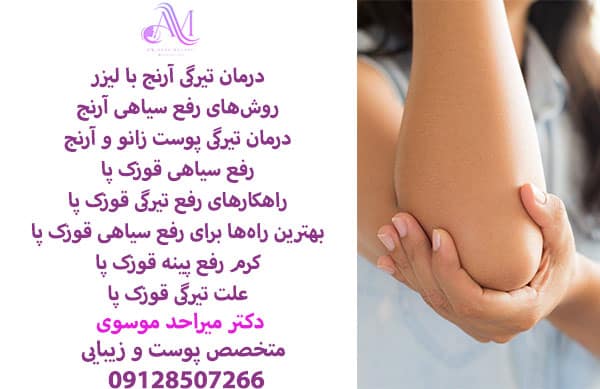 رفع تیرگی آرنج
