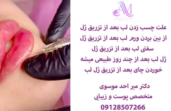 مراقبت های بعد از تزریق ژل لب