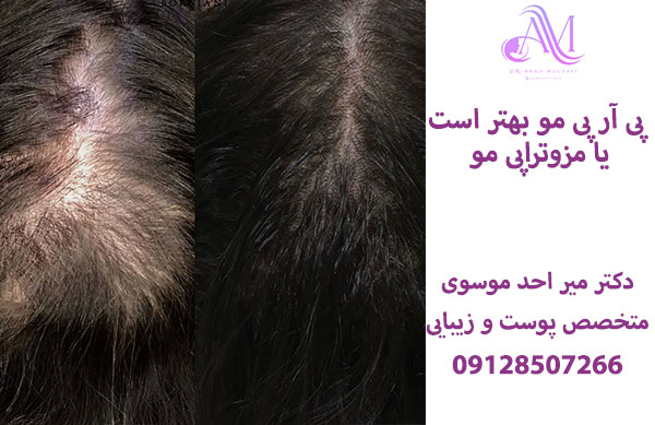پی آر پی مو بهتر است یا مزوتراپی مو