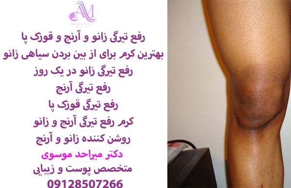 رفع تیرگی زانو و آرنج و قوزک پا