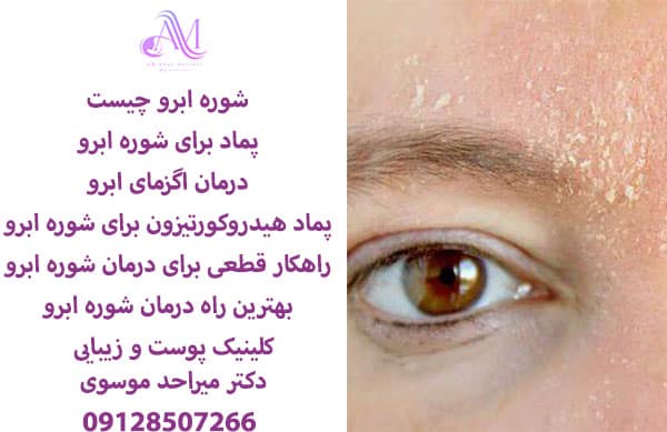 شوره ابرو چیست