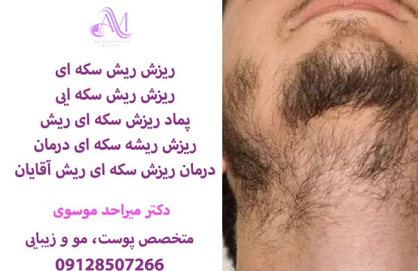 درمان ریزش ریش