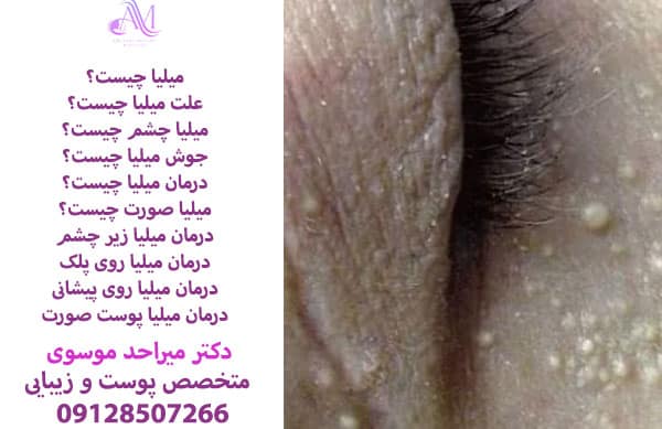 درمان میلیا