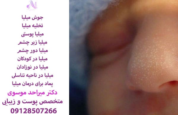 میلیا زیر چشم