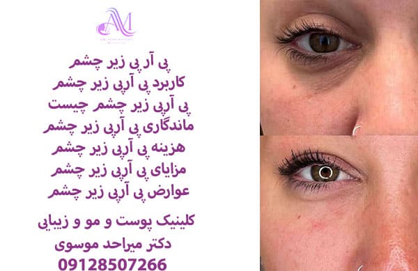 تزریق پی آر پی زیر چشم