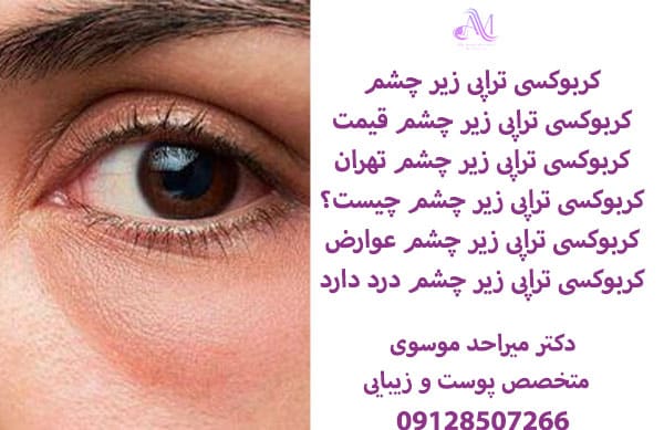 هزینه کربوکسی تراپی زیر چشم