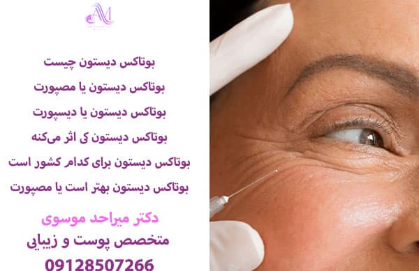 بوتاکس دیستون بهتر است یا مصپورت؟