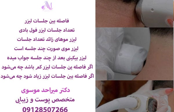 تعداد جلسات لیزر موهای زائد صورت
