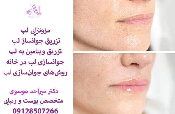 تزریق جوانساز لب