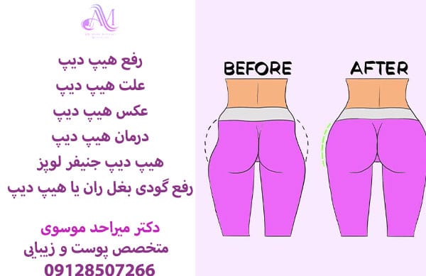 درمان هیپ دیپ با ورزش