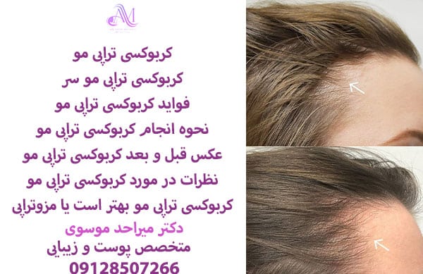 هزینه کربوکسی تراپی مو