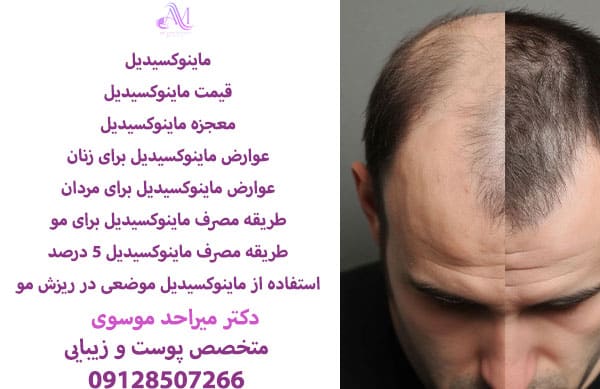 ماینوکسیدیل چیست و عوارض ماینوکسیدیل برای زنان، عوارض ماینوکسیدیل برای مردان و طریقه مصرف ماینوکسیدیل برای مو چیست؟