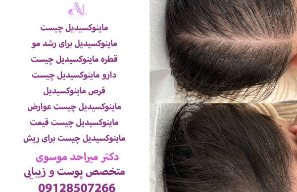 استفاده از ماینوکسیدیل بعد از کاشت مو برای افزایش رشد مو موثر است.