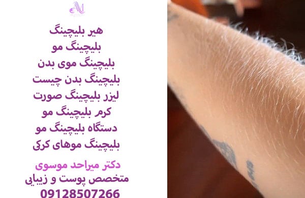 روشن کردن موها با لیزر بلیچینگ موقتی است و تنها در یک جلسه انجام می شود، پس از گذشت 1 تا 3 ماه نیاز به تکرار خواهید داشت.