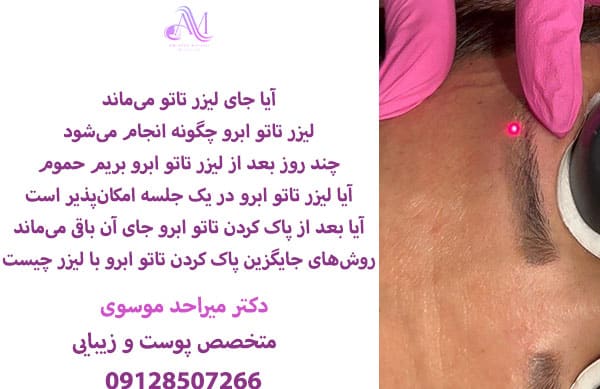 پاک کردن تاتو ابرو با لیزر کیوسوئیچ به عوامل مختلفی مانند عمق، نوع و وسعت رنگدانه های مورد استفاده دارد.