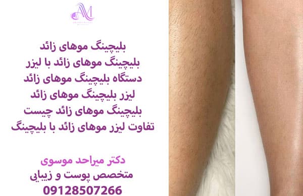 بلیچینگ موهای زائد یکی از بهترین روشها برای بهبود ظاهر موهای کرکی و نازک بدن است.