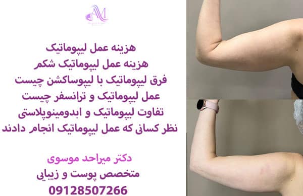 هزینه عمل لیپوماتیک بسته به تعداد نواحی مورد نیاز برای جراحی متغیر است.