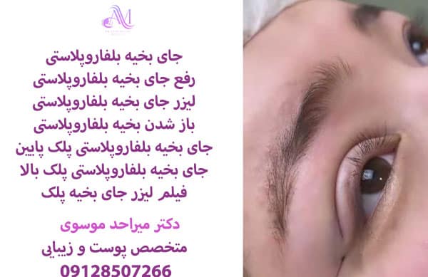 جای بخیه بلفاروپلاستی با استفاده از لیزر و استفاده به موقع از کرم ترمیم کننده به مرور زمان کمرنگ میشود.