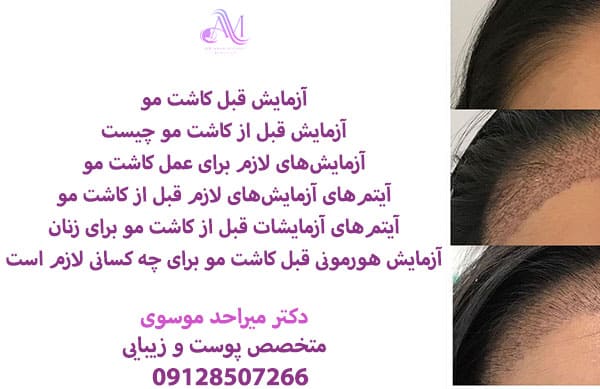 هزینه آزمایشات قبل از کاشت مو