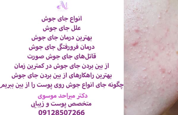 تعداد جلسات درمان جای جوش به عواملی مانند عمق و نوع جای جوش، نوع لیزر و پاسخ بدن به درمان بستگی دارد.