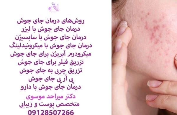 بهترین روش های درمان جای جوش