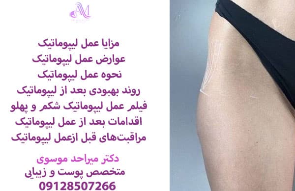 عمل لیپوماتیک ساعت شنی و لیپوماتیک ۳۶۰ درجه هر دو روش پیکرتراشی هستند که که طی آنها چربیهای اضافی بدن تخلیه میشود.