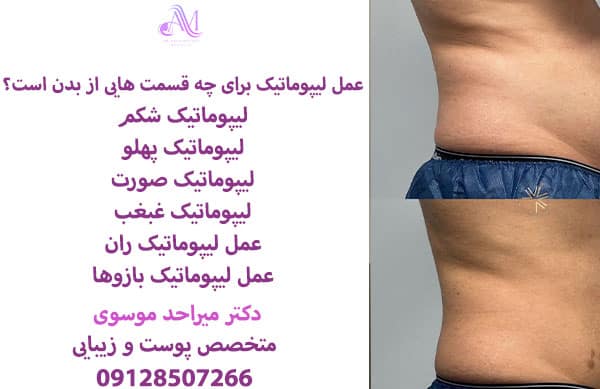 لیپوماتیک در واقع نوع پیشرفته روش لیپوساکشن است که برای نواحی مختلفی از بدن از جمله شکم،پهلوها،ران و بازوها انجام میشود.