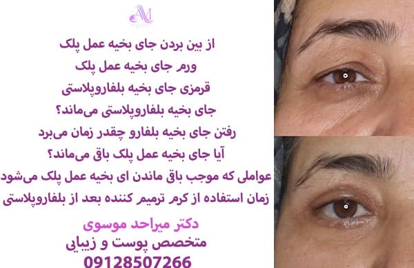 روشهایی برای از بین بردن بخیه پلک بالا و پایین استفاده می شود که شامل لیزر و کرمهای ترمیم کننده می شود. جای بخیه بلفارو معمولا در عرض 6 ماه تا یک سال بهبود پیدا می کند.