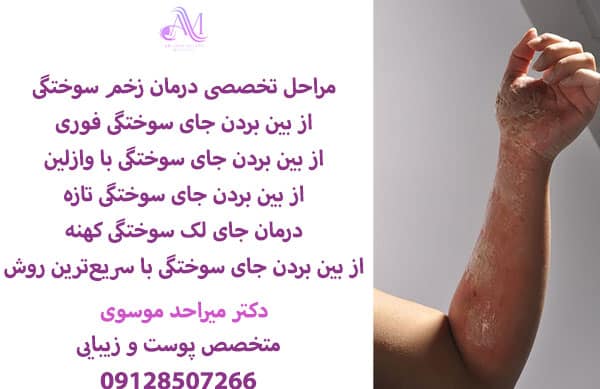 از بین بردن جای سوختگی با لیزر