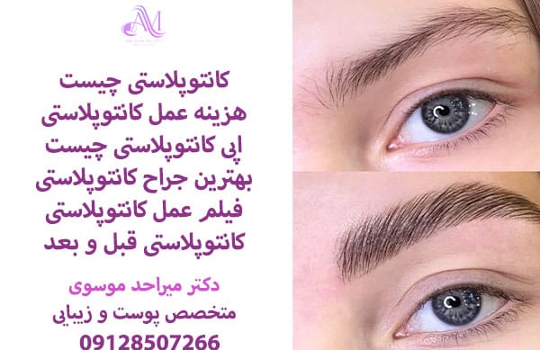 مزایا و معایب کانتوپلاستی و بلفاروپلاستی