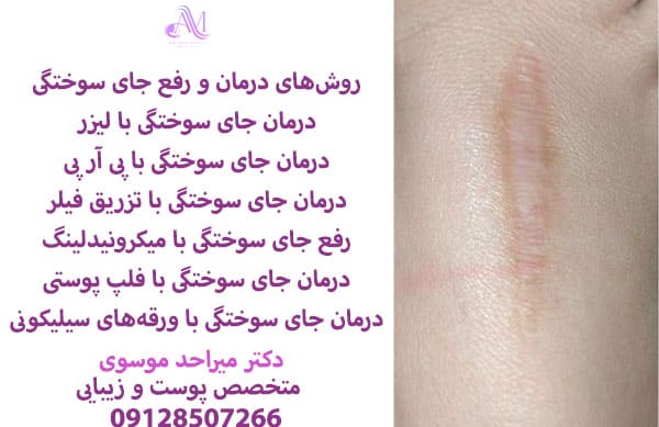 بهترین روش درمان جای سوختگی