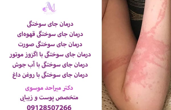 درمان جای سوختگی