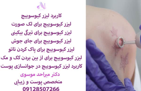 حذف تتو (خالکوبی) با لیزر کیوسوییچ