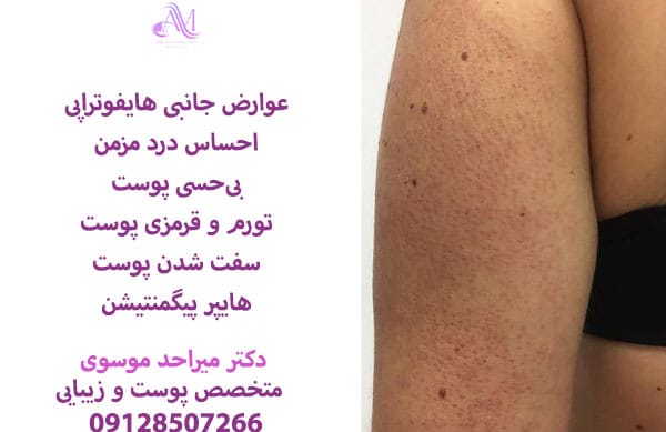 عوارض هایفوتراپی در کوتاه مدت