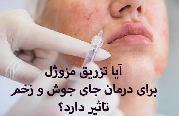 هزینه مزوژل برای جای جوش