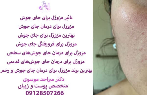 بهترین مزوژل برای درمان جای جوش و زخم