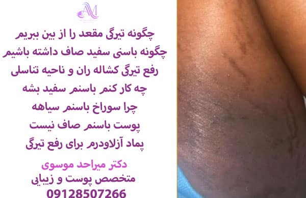 بهترین روش رفع تیرگی باسن و سفید کردن مقعد