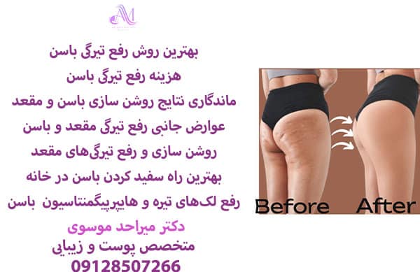 درمانهای پزشکی سفید کردن باسن