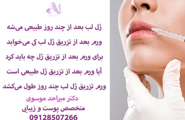از بین بردن ورم تزریق ژل به لب