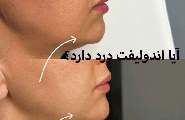 مقایسه درد اندولیفت با سایر روش های لیفتینگ صورت
