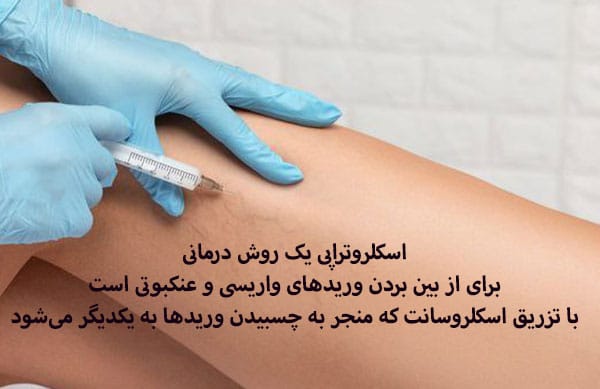 درمان رگ‌های عنکبوتی با اسکلروتراپی
