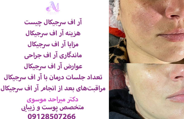 آر اف سرجیکال یک روش جراحی کم تهاجمی برای برداشتن ضایعههای پوستی است.