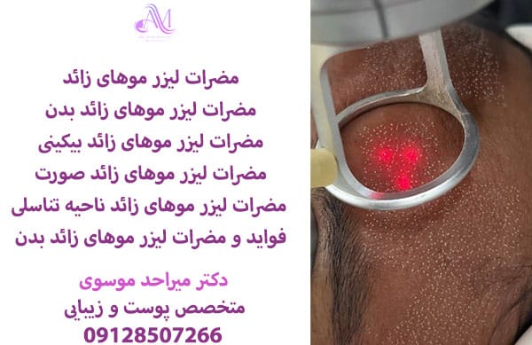 مضرات لیزر موهای زائد