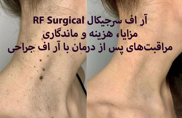 برداشتن خال با آر اف سرجیکال