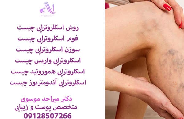 هزینه اسکلروتراپی واریس