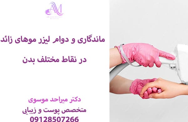 ماندگاری لیزر موهای زائد
