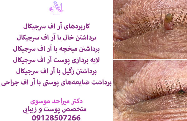 هزینه آر اف سرجیکال