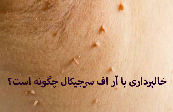 تعداد جلسات درمان با آر اف سرجیکال