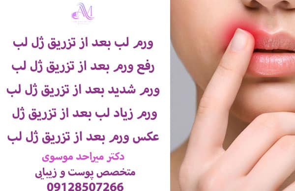 ورم لب بعد از تزریق ژل طبیعی است و 24 تا 48 ساعت بعد برطرف میشود.