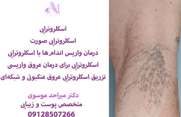 تعداد جلسات اسکلروتراپی